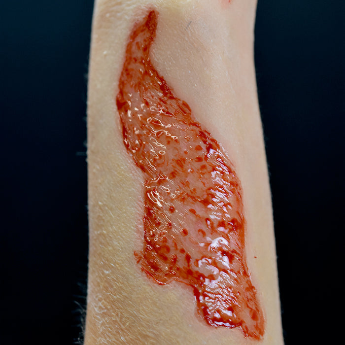 2nd Degree Burn 5