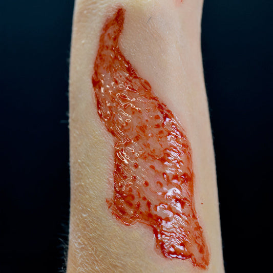 2nd Degree Burn 5